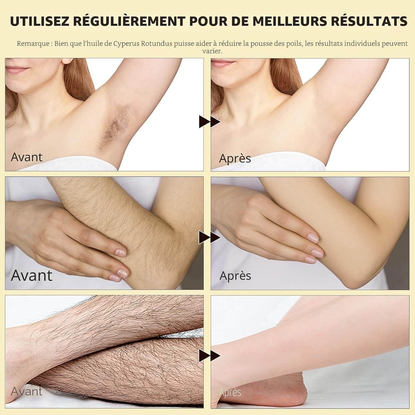 SmoothSkin™ – En finir avec les poils et les irritations après épilation